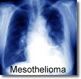 Mesothelioma X-ray