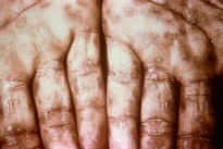 image of rash