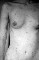 image of rash