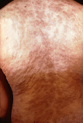 image of rash