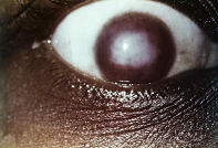 image of interstitial keratitis