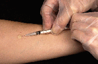 Tuberculin skin test